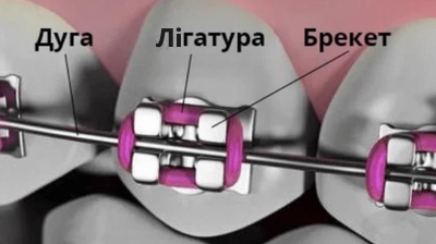 Лігатурні брекет-системи
